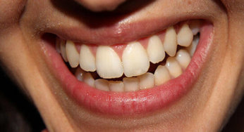 What Are Those White Spots On My Teeth?